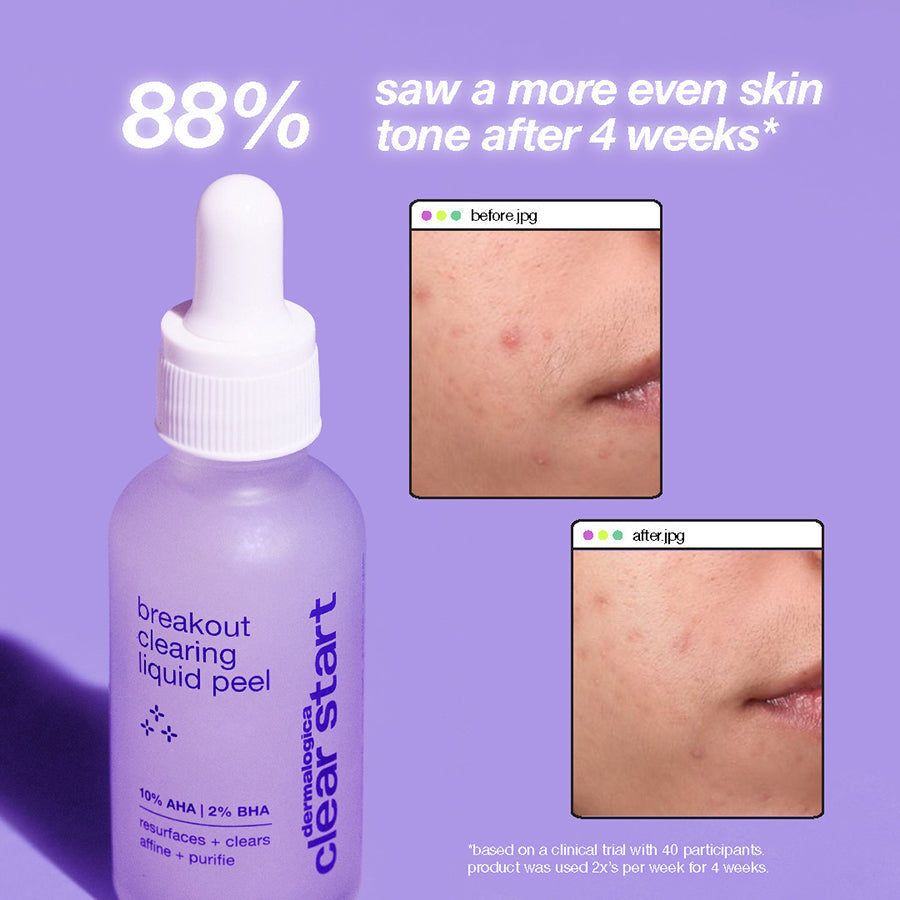 Breakout Clearing Liquid Peel 30ml